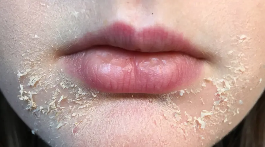 هۆکاری وشکبوونی پێست لە وەرزی پاییزدا ئاشکرا دەکرێت