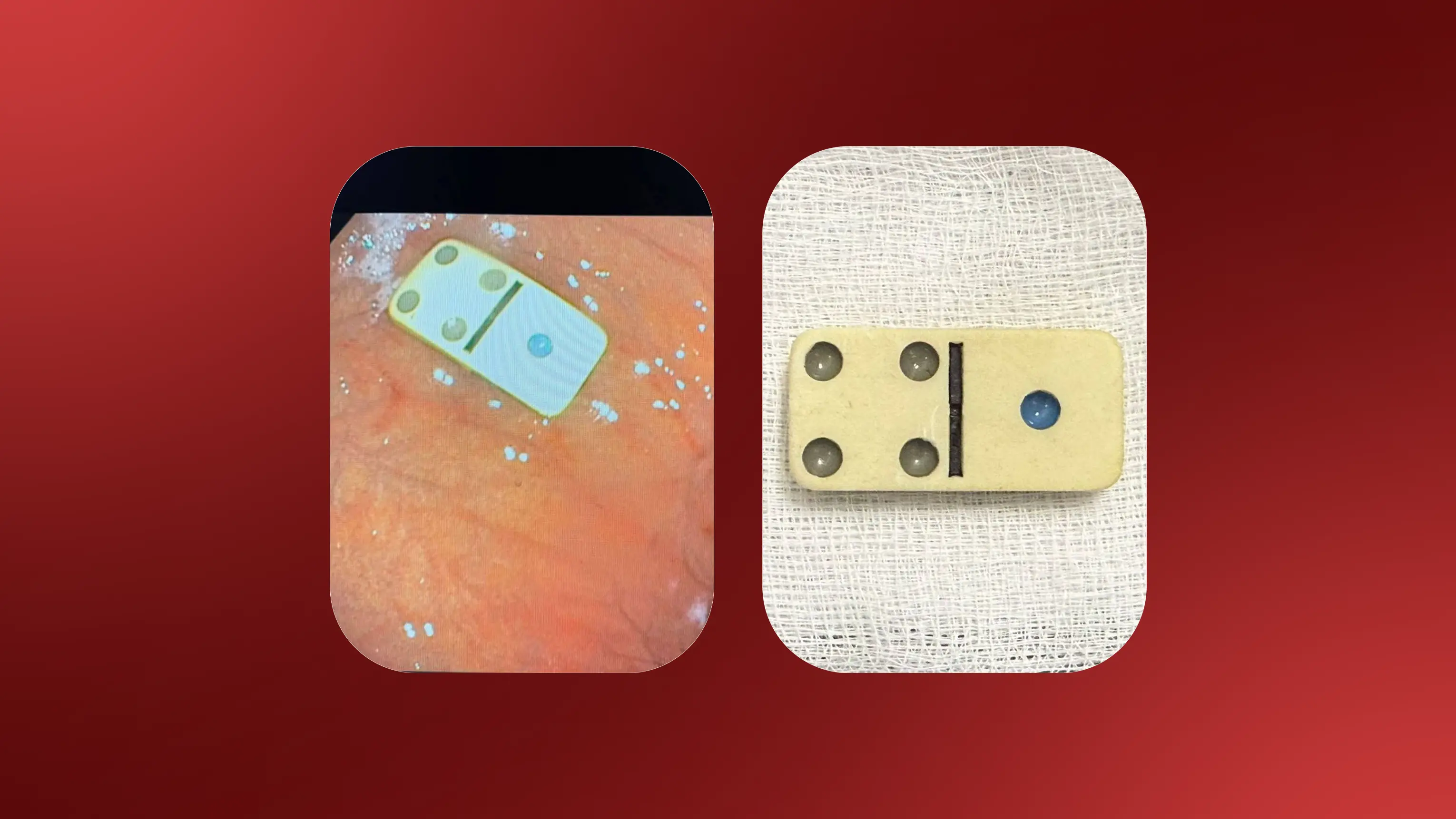 پولێكی دۆمینه‌ له‌ گه‌ده‌ی مێردمنداڵێك ده‌رهێندرا