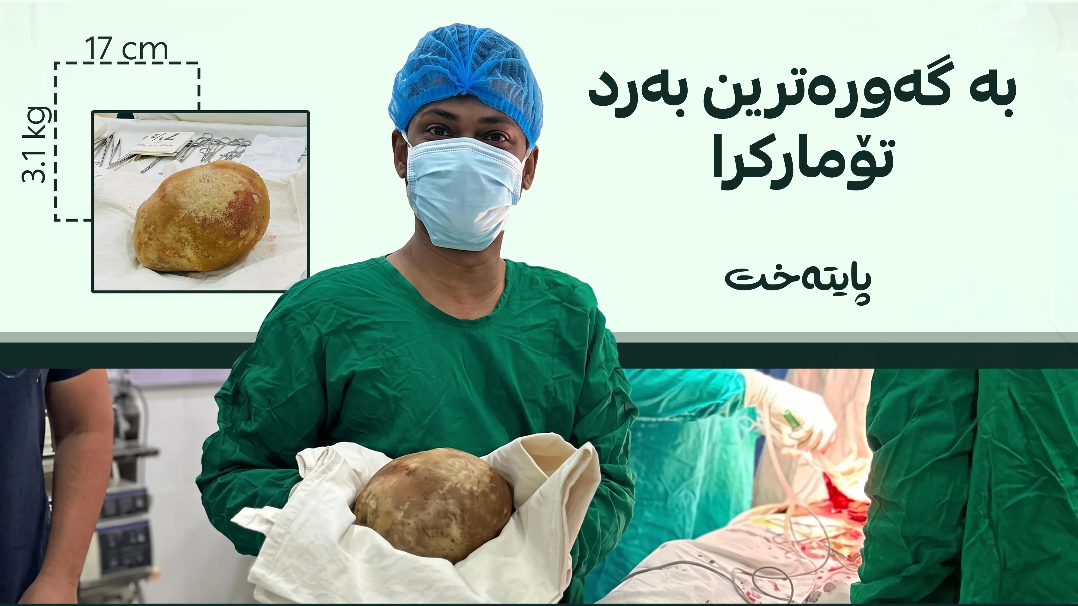 بەردێکی 3 کیلۆیی لە میزەڵدانی پیاوێک دەرهێنرا