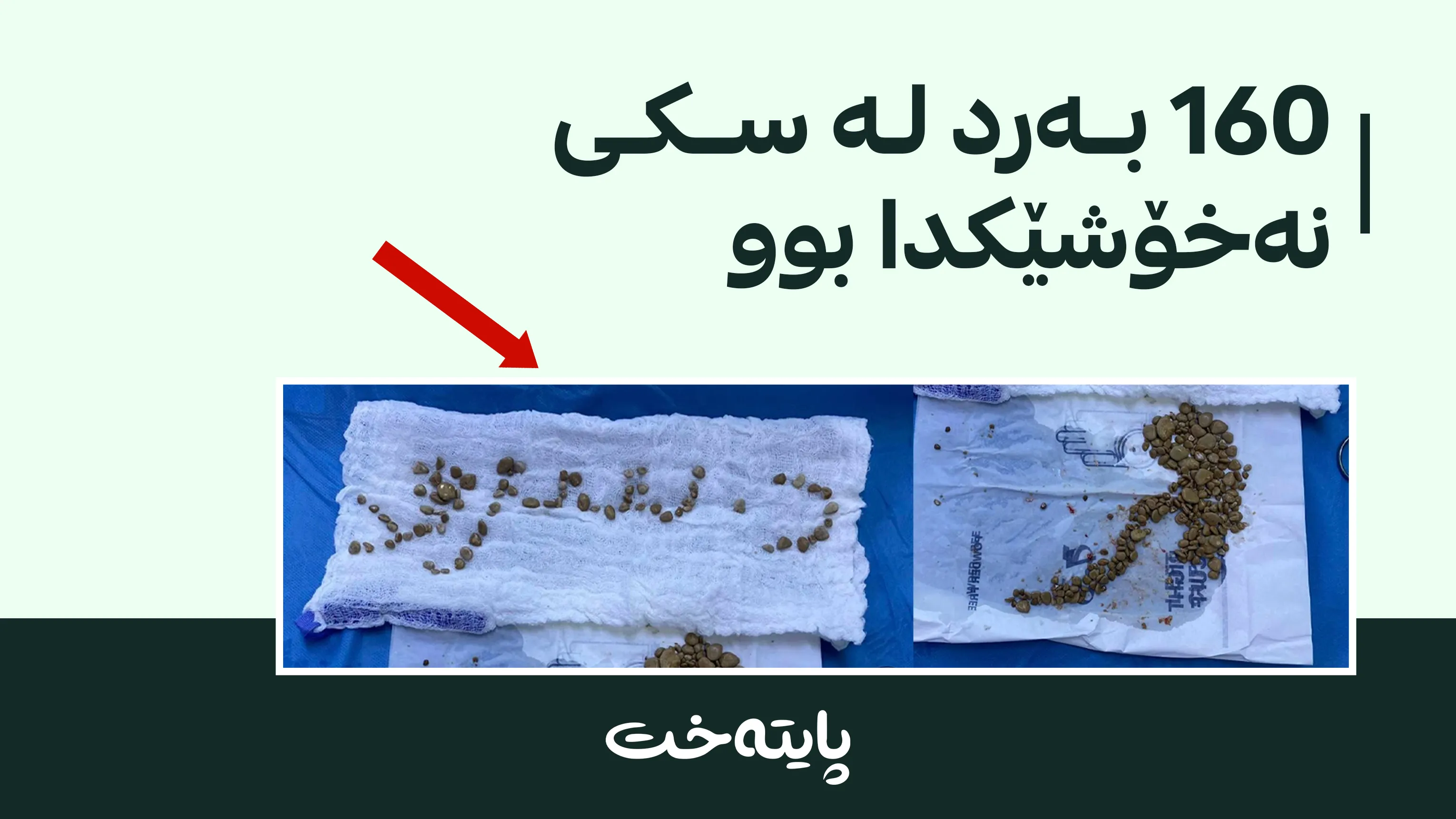 نەخۆشخانەی ڕزگاریی فێرکاری: زیاتر لە 160 بەرد لە میزڵدانی نەخۆشێک دەرهێنران