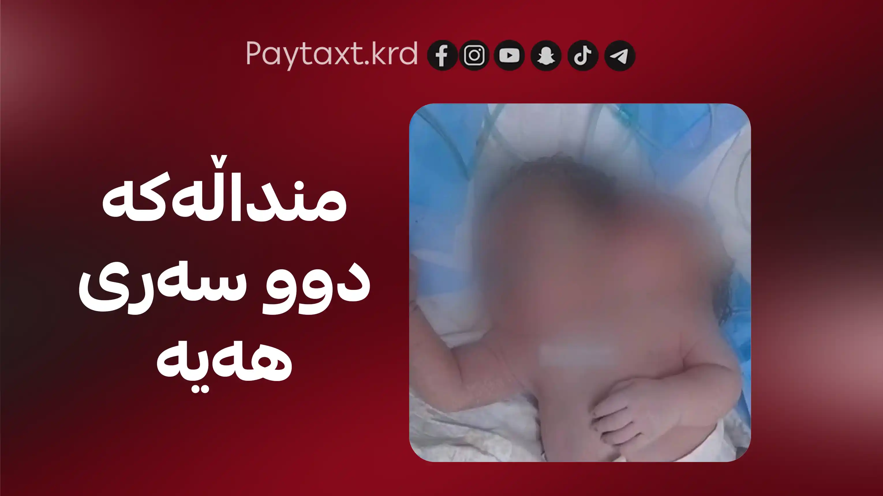 لە بەغدا منداڵێک بە دوو سەرەوە لە دایکبووە
