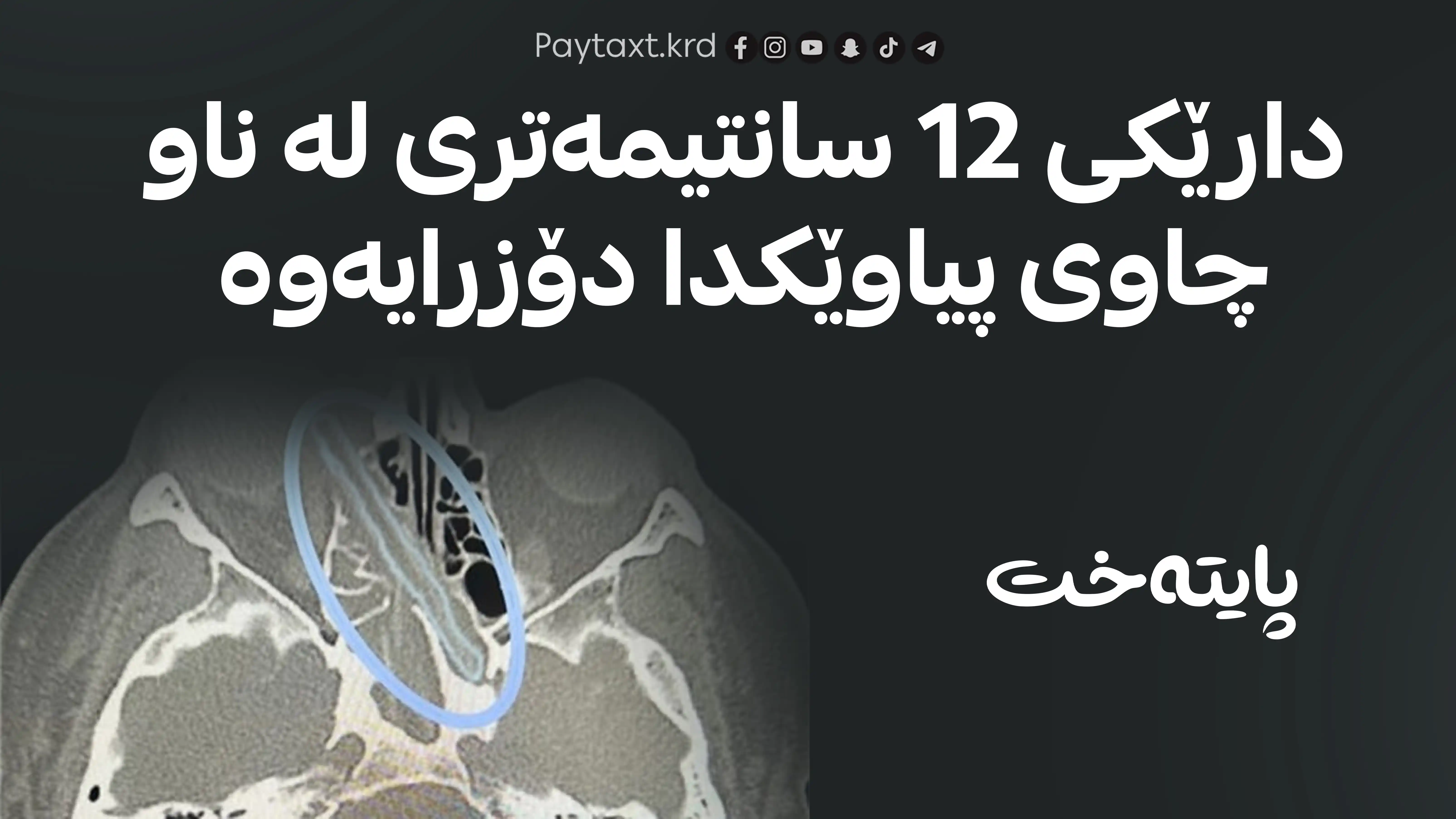 مێشکی لە مردن ڕزگاری بوو